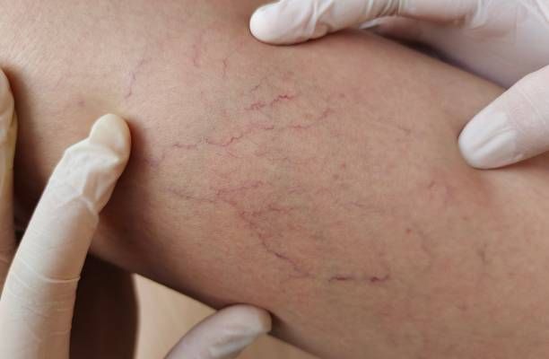 лечение на разширени вени - 29961 новини