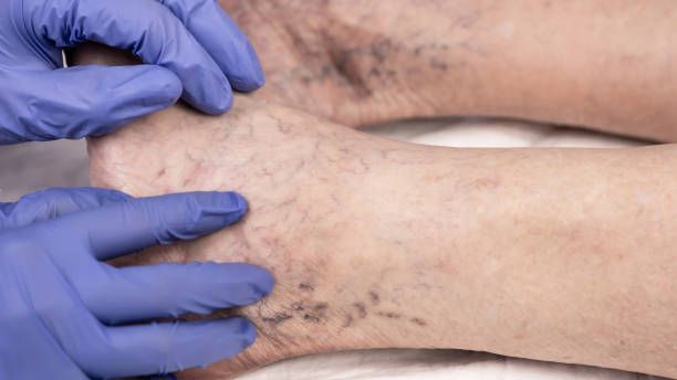 склеротерапия - 96702 варианти