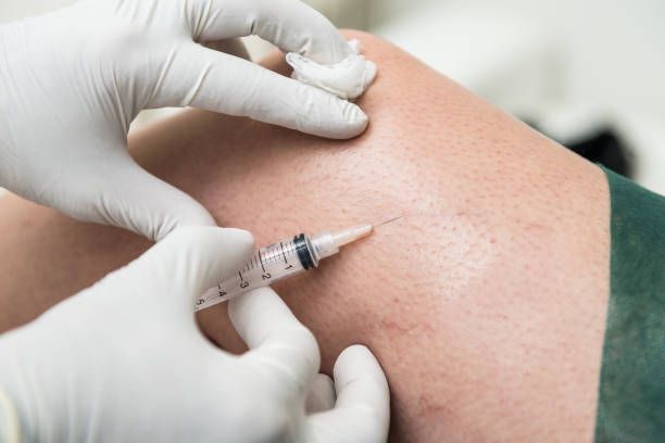 склеротерапия - 67424 разновидности